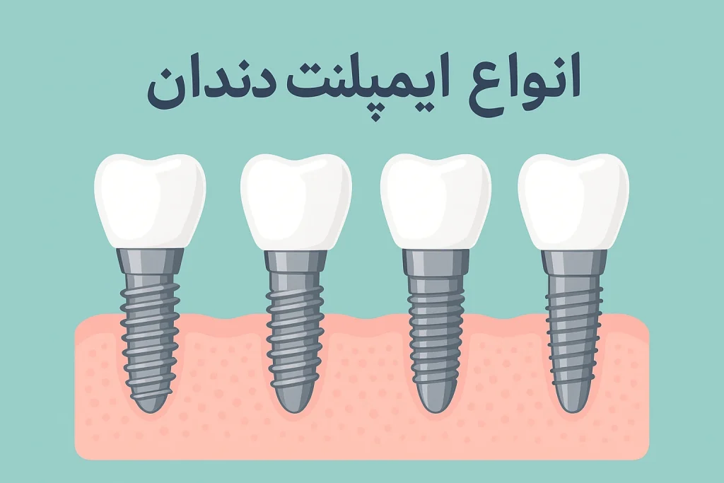انواع ایمپلنت دندان