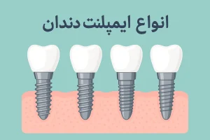 انواع ایمپلنت دندان