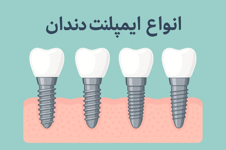 انواع ایمپلنت دندان