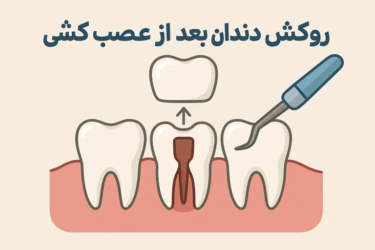 روکش دندان بعد از عصب کشی
