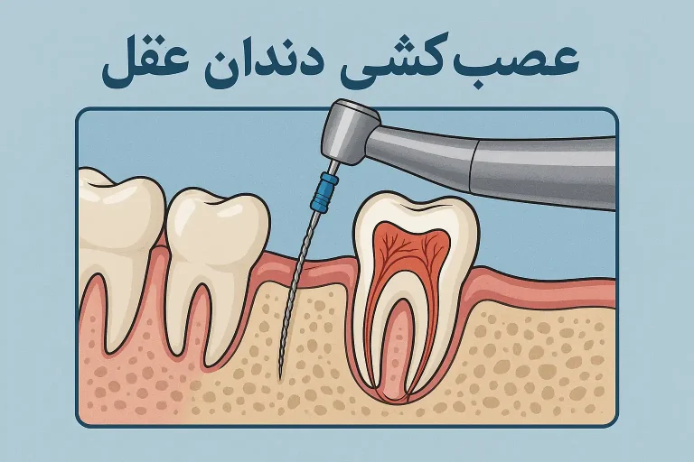 عصب کشی دندان عقل