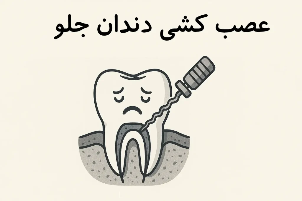 عصب کشی دندان جلو