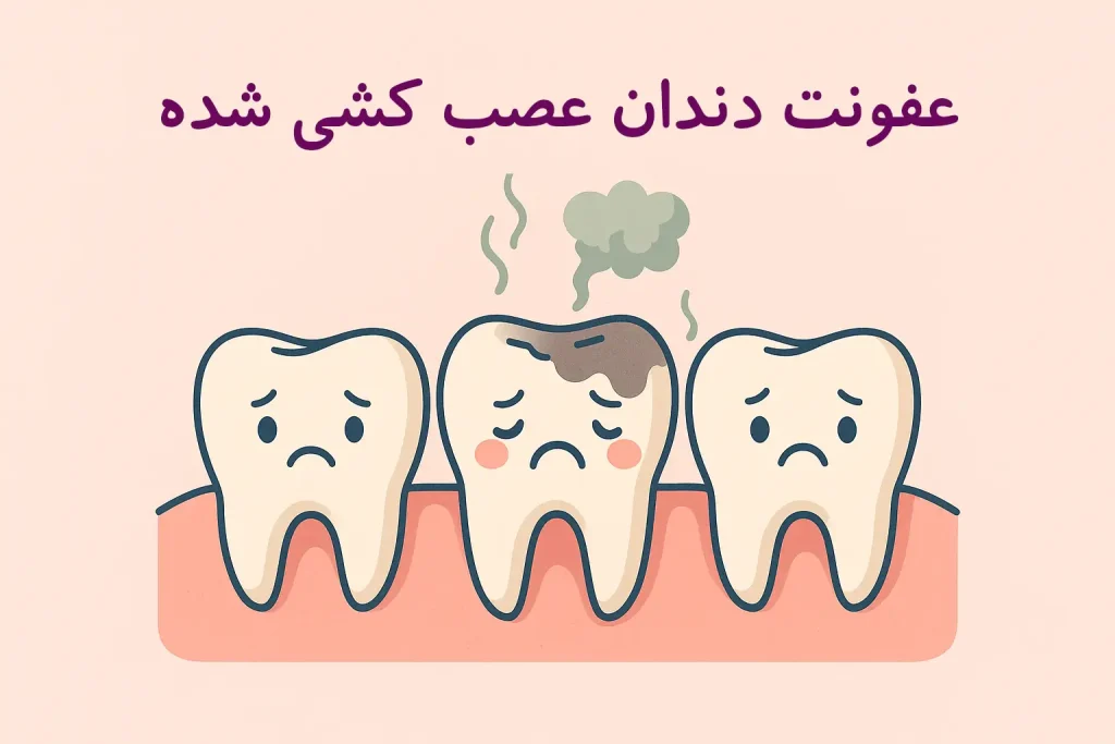 عفونت دندان عصب کشی شده