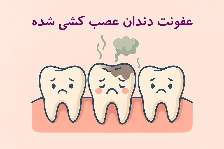 عفونت دندان عصب کشی شده