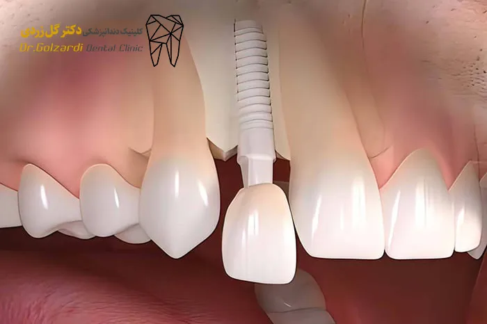 بهترین ایمپلنت دندان جلو