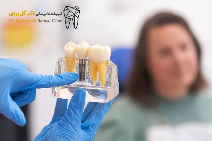 بهترین سن ایمپلنت دندان