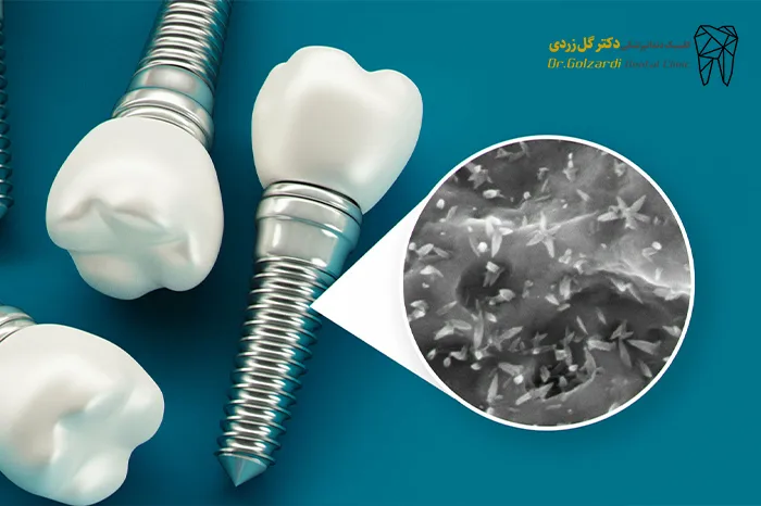 علائم عفونت ایمپلنت دندان