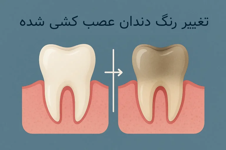 تغییر رنگ دندان عصب کشی شده
