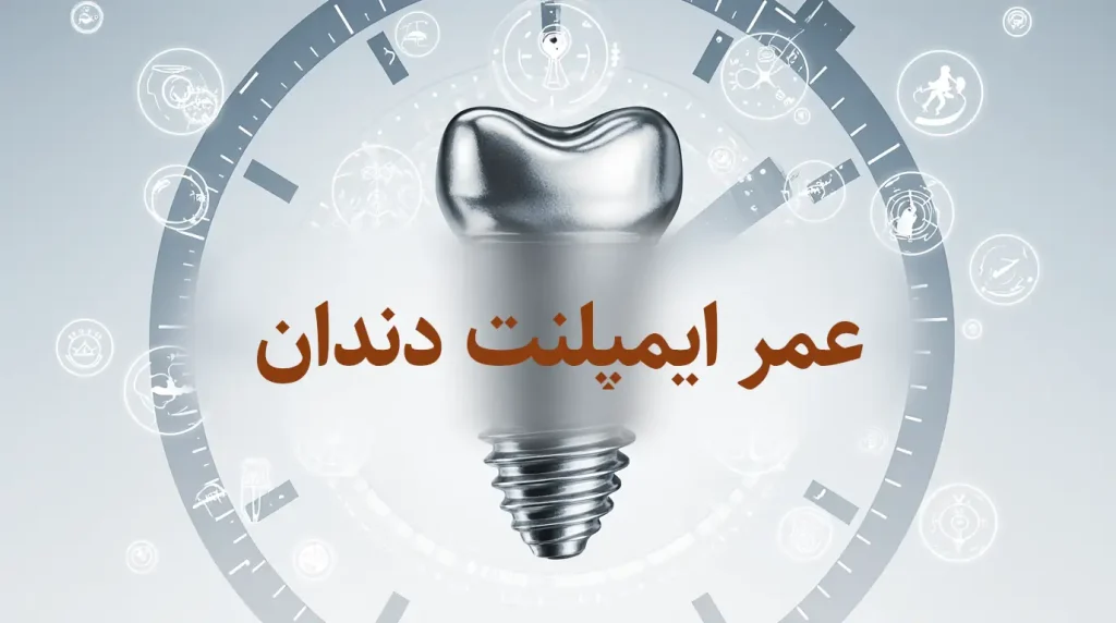 عمر ایمپلنت دندان