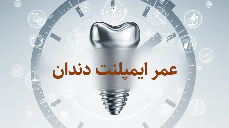 عمر ایمپلنت دندان