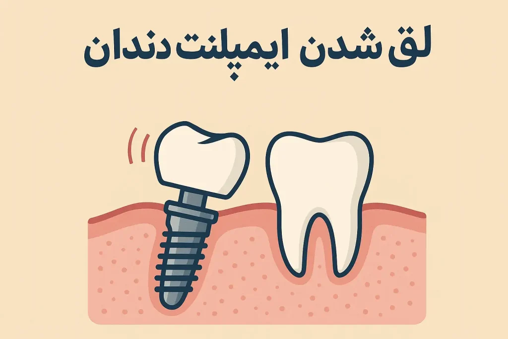لق شدن ایمپلنت دندان