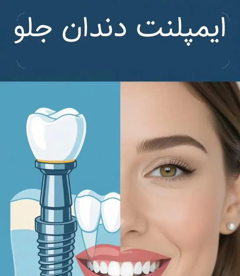 ایمپلنت دندان جلو