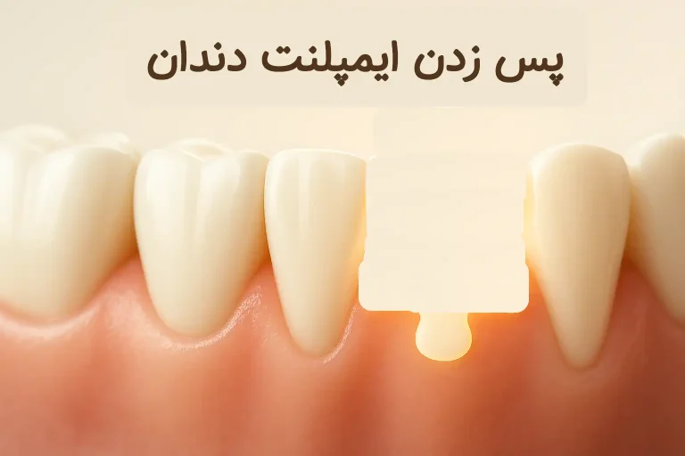 پس زدن ایمپلنت