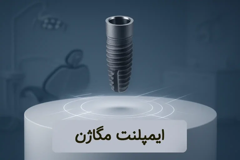 ایمپلنت مگاژن
