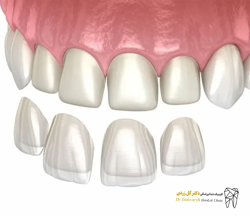 درباره لمینت دندان