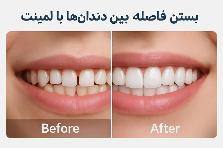 بستن فاصله بین دندان ها با لمینت