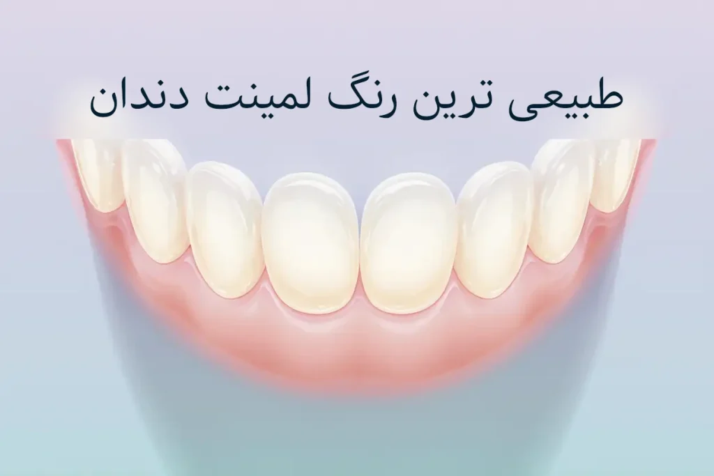 طبیعی ترین رنگ لمینت دندان
