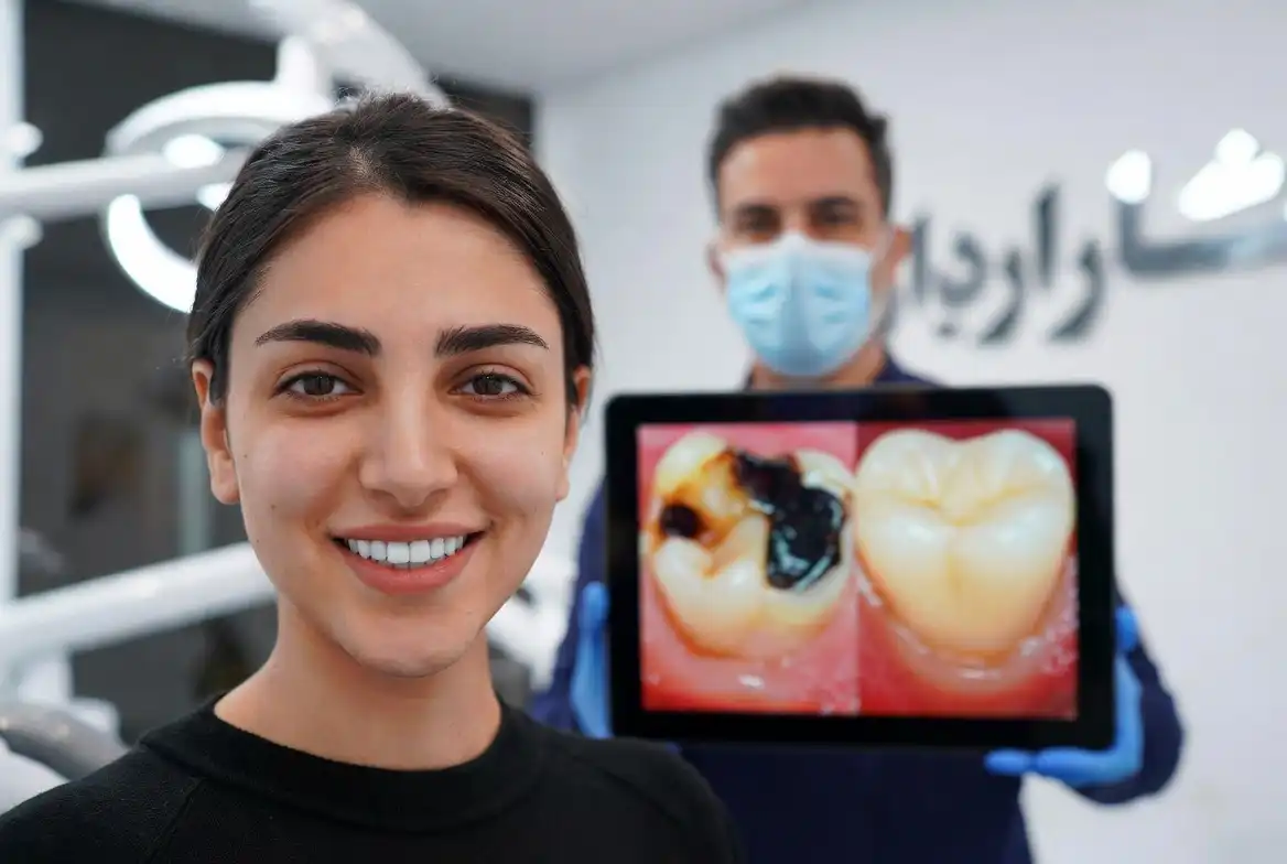 چگونگی بهبود طول عمر کامپوزیت دندان