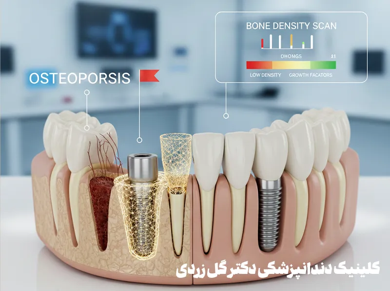 ایمپلنت دندان و پوکی استخوان