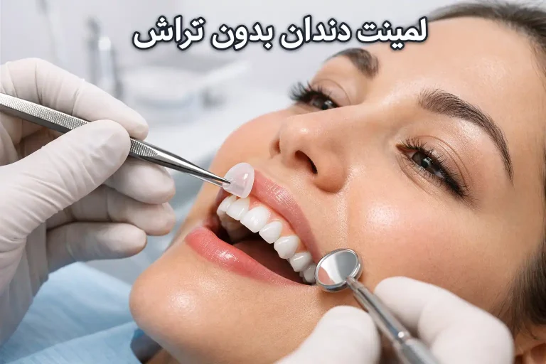لمینت دندان بدون تراش
