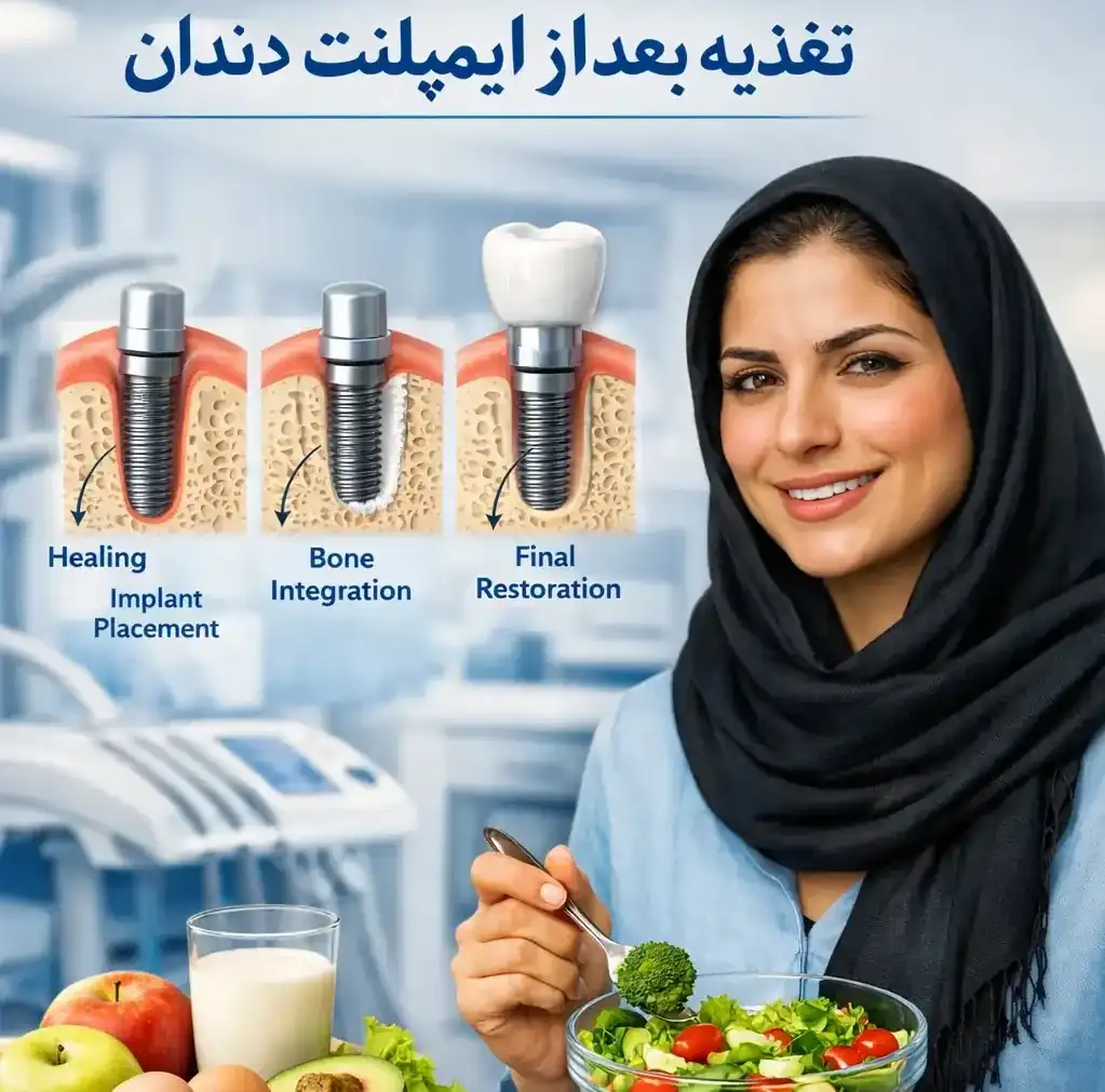 تغذیه بعد از ایمپلنت دندان