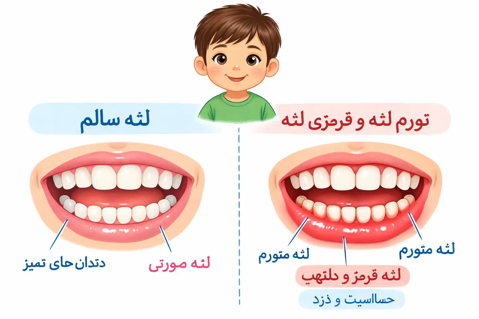 درمان تورم و قرمزی لثه در کودکان در شرق تهران